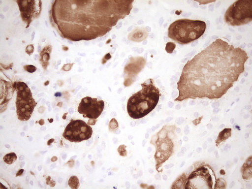 MMP3 Antibody - Immunohistochemical staining of paraffin-embedded Carcinoma of Human thyroid tissue using anti-MMP3 mouse monoclonal antibody. (Heat-induced epitope retrieval by 1 mM EDTA in 10mM Tris, pH8.5, 120C for 3min,