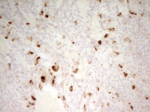 MMP3 Antibody - IHC of paraffin-embedded Carcinoma of Human lung tissue using anti-MMP3 mouse monoclonal antibody. (Heat-induced epitope retrieval by 1 mM EDTA in 10mM Tris, pH8.5, 120°C for 3min).