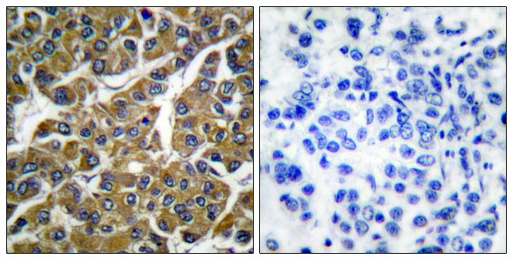 MMP3 Antibody - Immunohistochemistry analysis of paraffin-embedded human breast carcinoma tissue, using MMP-3 Antibody. The picture on the right is blocked with the synthesized peptide.
