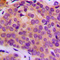 MMP3 Antibody - Immunohistochemical analysis of MMP3 staining in human breast cancer formalin fixed paraffin embedded tissue section. The section was pre-treated using heat mediated antigen retrieval with sodium citrate buffer (pH 6.0). The section was then incubated with the antibody at room temperature and detected using an HRP conjugated compact polymer system. DAB was used as the chromogen. The section was then counterstained with hematoxylin and mounted with DPX.