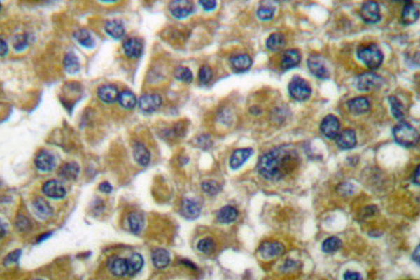 MMP3 Antibody - IHC of MMP-3 (S453) pAb in paraffin-embedded human breast carcinoma tissue.