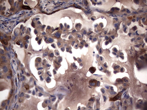 MMP7 / Matrilysin Antibody - Immunohistochemical staining of paraffin-embedded Carcinoma of Human lung tissue using anti-MMP7 mouse monoclonal antibody. (Heat-induced epitope retrieval by 1 mM EDTA in 10mM Tris, pH8.5, 120C for 3min,
