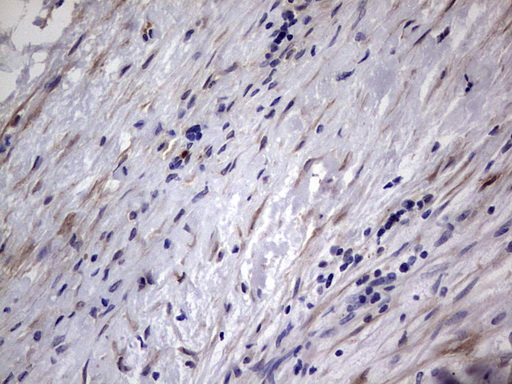 MMP7 / Matrilysin Antibody - Immunohistochemical staining of paraffin-embedded Adenocarcinoma of Human ovary tissue using anti-MMP7 mouse monoclonal antibody. (Heat-induced epitope retrieval by 1 mM EDTA in 10mM Tris, pH8.5, 120C for 3min,