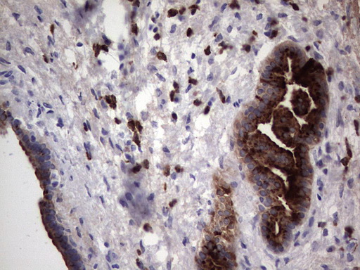 MMP7 / Matrilysin Antibody - Immunohistochemical staining of paraffin-embedded Carcinoma of Human pancreas tissue using anti-MMP7 mouse monoclonal antibody. (Heat-induced epitope retrieval by 1 mM EDTA in 10mM Tris, pH8.5, 120C for 3min,