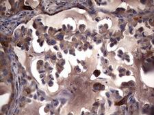 MMP7 / Matrilysin Antibody - IHC of paraffin-embedded Carcinoma of Human lung tissue using anti-MMP7 mouse monoclonal antibody. (Heat-induced epitope retrieval by 1 mM EDTA in 10mM Tris, pH8.5, 120°C for 3min).