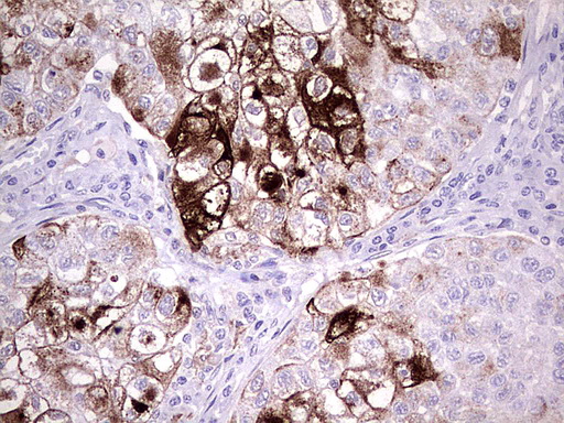 MMP7 / Matrilysin Antibody - Immunohistochemical staining of paraffin-embedded Carcinoma of Human lung tissue using anti-MMP7 mouse monoclonal antibody.  heat-induced epitope retrieval by 1 mM EDTA in 10mM Tris, pH8.0, 120C for 3min)