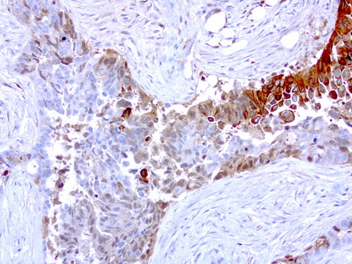 MMP7 / Matrilysin Antibody - Immunohistochemical staining of paraffin-embedded human endometrial carcinoma using anti-MMP7 clone UMAB168 mouse monoclonal antibody at 1:200 dilution 1mg/mL and detection with Polink2 Broad HRP DAB.requires heat-induced epitope retrieval with EDTA pH 8.0 in a presure cooker for 3 minutes at 110C. The image shows strong membranous and cytoplasmic staining in the tumor cells.