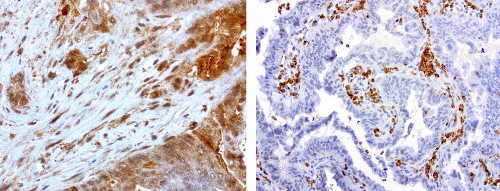 MMP7 / Matrilysin Antibody - Immunohistochemical staining of paraffin-embedded human gastric tumor using anti-MMP7 clone UMAB168 mouse monoclonal antibody at 1:200 dilution 1mg/mL and detection with Polink2 Broad HRP DAB.requires heat-induced epitope retrieval with EDTA pH 8.0 in a presure cooker for 3 minutes at 110C. The composit image shows two tumors with membranous and cytoplasmic staining in the tumor cells.