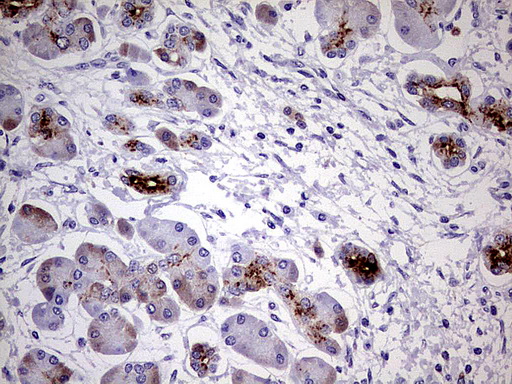 MMP7 / Matrilysin Antibody - Immunohistochemical staining of paraffin-embedded Carcinoma of Human pancreas tissue using anti-MMP7 mouse monoclonal antibody.  heat-induced epitope retrieval by 1 mM EDTA in 10mM Tris, pH8.0, 120C for 3min)