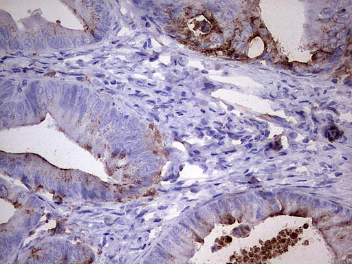 MMP7 / Matrilysin Antibody - Immunohistochemical staining of paraffin-embedded Adenocarcinoma of Human colon tissue using anti-MMP7 mouse monoclonal antibody.  heat-induced epitope retrieval by 1 mM EDTA in 10mM Tris, pH8.0, 120C for 3min)