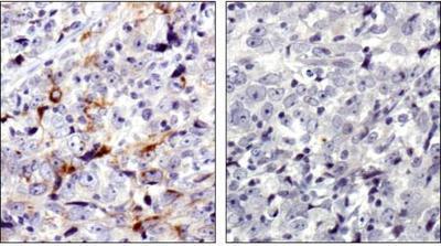 MMP7 / Matrilysin Antibody - Immunohistochemistry: MMP7 Antibody - MMP7 antibody was tested in human breast cancer using DAB with hematoxylin counterstain. The image on the right had the antibody blocked by preincubation with immunizing peptide.  This image was taken for the unconjugated form of this product. Other forms have not been tested.
