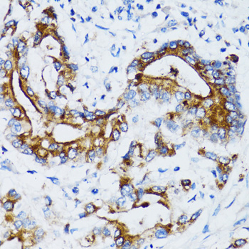 MMP7 / Matrilysin Antibody - Immunohistochemistry of paraffin-embedded human colon carcinoma using MMP7 antibodyat dilution of 1:100 (40x lens).