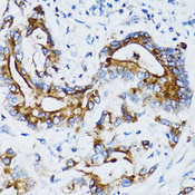 MMP7 / Matrilysin Antibody - Immunohistochemistry of paraffin-embedded human colon carcinoma using MMP7 antibodyat dilution of 1:100 (40x lens).