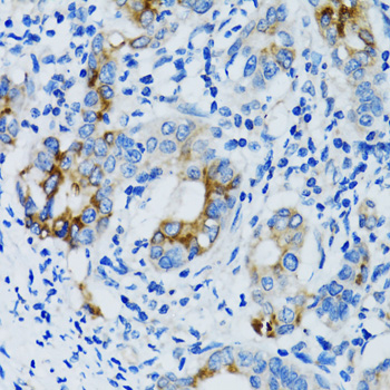 MMP7 / Matrilysin Antibody - Immunohistochemistry of paraffin-embedded human gastric cancer using MMP7 antibodyat dilution of 1:100 (40x lens).