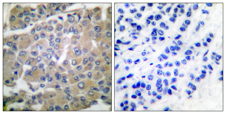 MMP8 Antibody - Immunohistochemistry analysis of paraffin-embedded human breast carcinoma tissue, using MMP-8 Antibody. The picture on the right is blocked with the synthesized peptide.