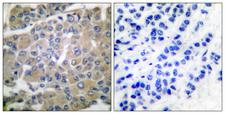 MMP8 Antibody - Immunohistochemistry analysis of paraffin-embedded human breast carcinoma tissue, using MMP-8 Antibody. The picture on the right is blocked with the synthesized peptide.