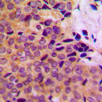 MMP8 Antibody - Immunohistochemical analysis of MMP8 staining in human breast cancer formalin fixed paraffin embedded tissue section. The section was pre-treated using heat mediated antigen retrieval with sodium citrate buffer (pH 6.0). The section was then incubated with the antibody at room temperature and detected using an HRP conjugated compact polymer system. DAB was used as the chromogen. The section was then counterstained with hematoxylin and mounted with DPX.