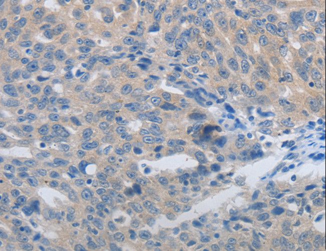 MMP8 Antibody - Immunohistochemistry of paraffin-embedded Human ovarian cancer using MMP8 Polyclonal Antibody at dilution of 1:45.