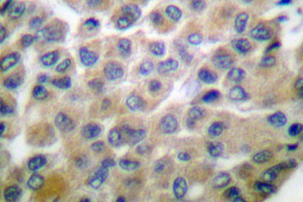 MMP8 Antibody - IHC of MMP-8 (F445) pAb in paraffin-embedded human breast carcinoma tissue.