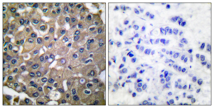 MMP9 / Gelatinase B Antibody - Immunohistochemistry analysis of paraffin-embedded human breast carcinoma tissue, using MMP-9 Antibody. The picture on the right is blocked with the synthesized peptide.