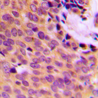 MMP9 / Gelatinase B Antibody - Immunohistochemical analysis of MMP9 staining in human breast cancer formalin fixed paraffin embedded tissue section. The section was pre-treated using heat mediated antigen retrieval with sodium citrate buffer (pH 6.0). The section was then incubated with the antibody at room temperature and detected using an HRP conjugated compact polymer system. DAB was used as the chromogen. The section was then counterstained with hematoxylin and mounted with DPX.