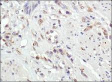 MMP9 / Gelatinase B Antibody - Immunohistochemistry: MMP9 Antibody (4A3) - IHC of MMP9 in human esophagus tumor using DAB with hematoxylin counterstain.  This image was taken for the unconjugated form of this product. Other forms have not been tested.