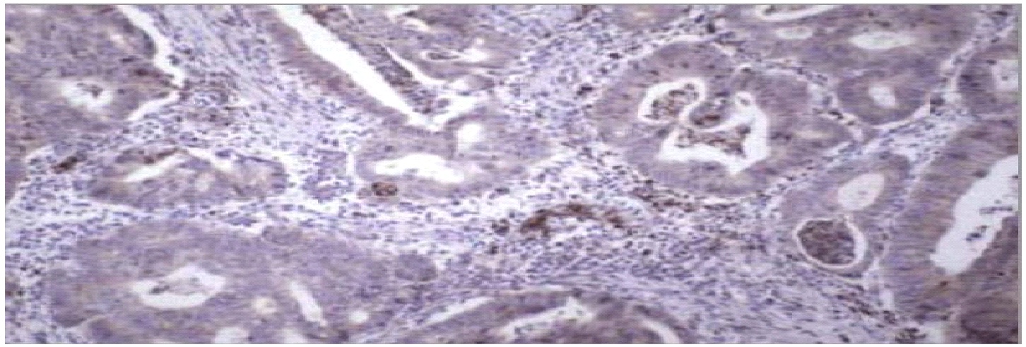 MMP9 / Gelatinase B Antibody - Left: IHC of paraffin embedded colon carcinoma using MMP9 antibody (Matrix Metalloproteinase 9 (MMP9)). Antigen retrieval using 10mM citrate buffer and microwave method was used. Right: Western blot of MMP9 antibody on recombinant human proenzyme MMP9 (400 ng/lane). 