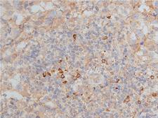 MMP9 / Gelatinase B Antibody - 1:50 staining human breast carcinoma tissue by IHC-P. The tissue was formaldehyde fixed and a heat mediated antigen retrieval step in citrate buffer was performed. The tissue was then blocked and incubated with the antibody for 1.5 hours at 22°C. An HRP conjugated goat anti-rabbit antibody was used as the secondary.