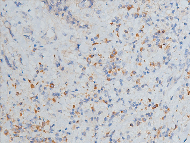 MMP9 / Gelatinase B Antibody - 1:200 staining human breast carcinoma tissue by IHC-P. The tissue was formaldehyde fixed and a heat mediated antigen retrieval step in citrate buffer was performed. The tissue was then blocked and incubated with the antibody for 1.5 hours at 22°C. An HRP conjugated goat anti-rabbit antibody was used as the secondary.
