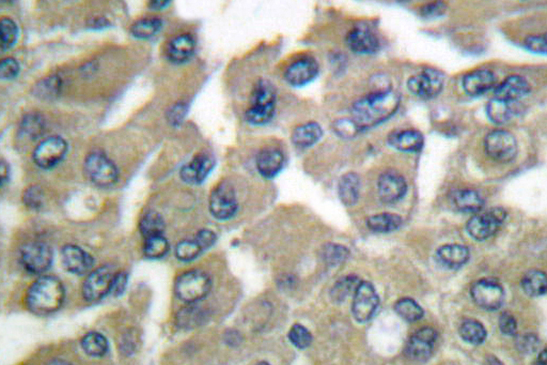 MMP9 / Gelatinase B Antibody - IHC of MMP-9 (W680) pAb in paraffin-embedded human breast carcinoma tissue.