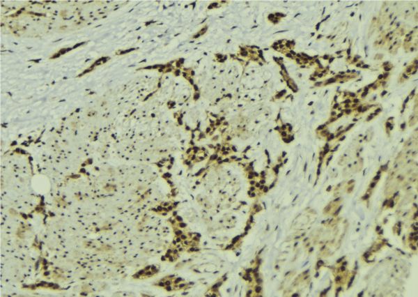 MMS19 Antibody - 1:100 staining human breast carcinoma tissue by IHC-P. The sample was formaldehyde fixed and a heat mediated antigen retrieval step in citrate buffer was performed. The sample was then blocked and incubated with the antibody for 1.5 hours at 22°C. An HRP conjugated goat anti-rabbit antibody was used as the secondary.