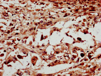 MMS21 / NSMCE2 Antibody - IHC image of NSMCE2 Antibody diluted at 1:600 and staining in paraffin-embedded human melanoma performed on a Leica BondTM system. After dewaxing and hydration, antigen retrieval was mediated by high pressure in a citrate buffer (pH 6.0). Section was blocked with 10% normal goat serum 30min at RT. Then primary antibody (1% BSA) was incubated at 4°C overnight. The primary is detected by a biotinylated secondary antibody and visualized using an HRP conjugated SP system.