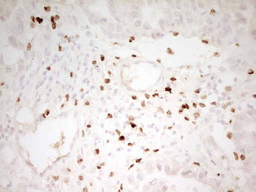 MNDA Antibody - Immunohistochemical staining of paraffin-embedded Adenocarcinoma of Human ovary tissue using anti-MNDA mouse monoclonal antibody. (Heat-induced epitope retrieval by 1 mM EDTA in 10mM Tris, pH8.5, 120C for 3min,