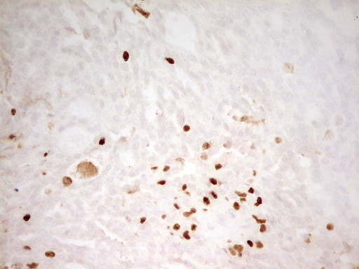 MNDA Antibody - Immunohistochemical staining of paraffin-embedded Adenocarcinoma of Human breast tissue using anti-MNDA mouse monoclonal antibody. (Heat-induced epitope retrieval by 1 mM EDTA in 10mM Tris, pH8.5, 120C for 3min,