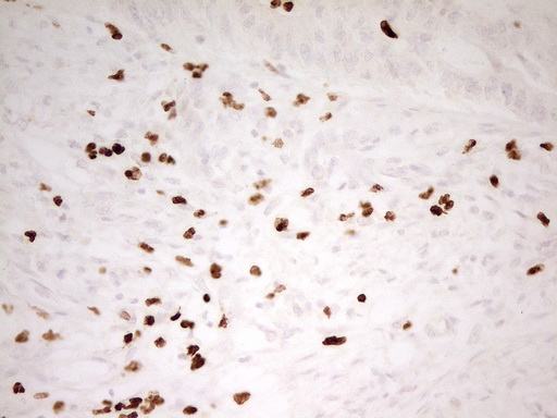 MNDA Antibody - Immunohistochemical staining of paraffin-embedded Adenocarcinoma of Human colon tissue using anti-MNDA mouse monoclonal antibody. (Heat-induced epitope retrieval by 1 mM EDTA in 10mM Tris, pH8.5, 120C for 3min,
