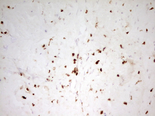 MNDA Antibody - Immunohistochemical staining of paraffin-embedded Carcinoma of Human liver tissue using anti-MNDA mouse monoclonal antibody. (Heat-induced epitope retrieval by 1 mM EDTA in 10mM Tris, pH8.5, 120C for 3min,