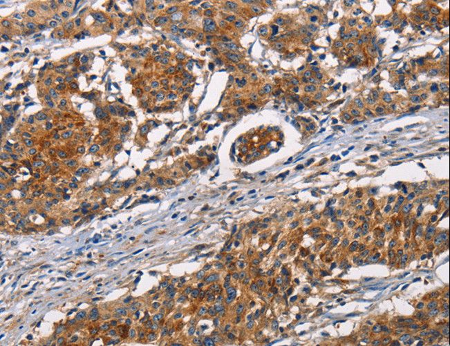 MNK / ATP7A Antibody - Immunohistochemistry of paraffin-embedded Human gastric cancer using ATP7A Polyclonal Antibody at dilution of 1:50.