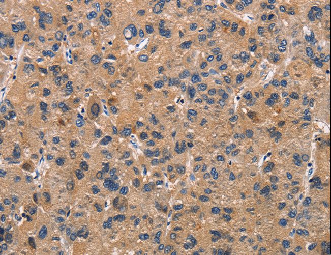 MNK / ATP7A Antibody - Immunohistochemistry of paraffin-embedded Human liver cancer using ATP7A Polyclonal Antibody at dilution of 1:50.