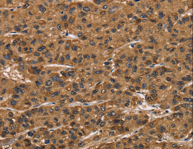 MNK / ATP7A Antibody - Immunohistochemistry of paraffin-embedded Human breast cancer using ATP7A Polyclonal Antibody at dilution of 1:50.