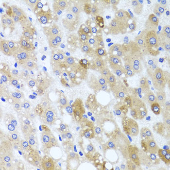 MNK / ATP7A Antibody - Immunohistochemistry of paraffin-embedded human liver injury tissue.