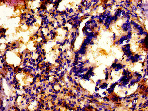 MNK / ATP7A Antibody - Immunohistochemistry image at a dilution of 1:500 and staining in paraffin-embedded human lung tissue performed on a Leica BondTM system. After dewaxing and hydration, antigen retrieval was mediated by high pressure in a citrate buffer (pH 6.0) . Section was blocked with 10% normal goat serum 30min at RT. Then primary antibody (1% BSA) was incubated at 4 °C overnight. The primary is detected by a biotinylated secondary antibody and visualized using an HRP conjugated SP system.