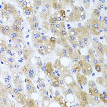 MNK / ATP7A Antibody - Immunohistochemistry of paraffin-embedded Human liver damage using ATP7A Polyclonal Antibody at dilution of 1:100 (40x lens).