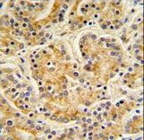 MOB1A Antibody - MOBKL1B Antibody IHC of formalin-fixed and paraffin-embedded human Prostate carcinoma followed by peroxidase-conjugated secondary antibody and DAB staining.