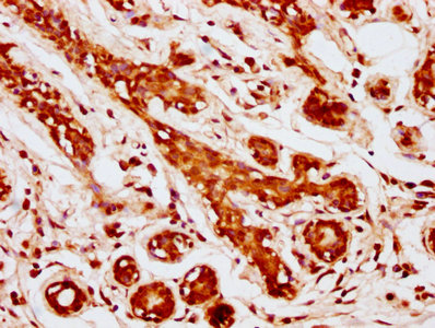 MOB1A Antibody - IHC image of MOB1A Antibody diluted at 1:1000 and staining in paraffin-embedded human breast cancer performed on a Leica BondTM system. After dewaxing and hydration, antigen retrieval was mediated by high pressure in a citrate buffer (pH 6.0). Section was blocked with 10% normal goat serum 30min at RT. Then primary antibody (1% BSA) was incubated at 4°C overnight. The primary is detected by a biotinylated secondary antibody and visualized using an HRP conjugated SP system.