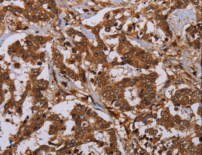 MOB1A Antibody - Immunohistochemistry of paraffin-embedded Human liver cancer using MOB1A Polyclonal Antibody at dilution of 1:30.