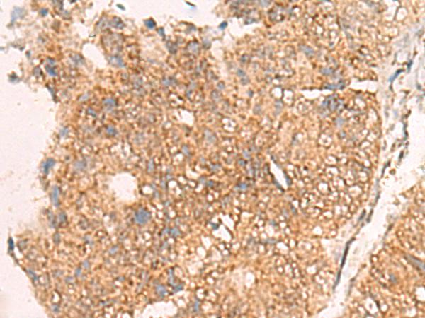 MOB1A Antibody - Immunohistochemistry of paraffin-embedded Human colorectal cancer tissue  using MOB1A Polyclonal Antibody at dilution of 1:50(×200)