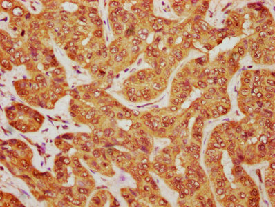 MOB1B / MOBKL1A Antibody - IHC image of MOB1B Antibody diluted at 1:1200 and staining in paraffin-embedded human liver cancer performed on a Leica BondTM system. After dewaxing and hydration, antigen retrieval was mediated by high pressure in a citrate buffer (pH 6.0). Section was blocked with 10% normal goat serum 30min at RT. Then primary antibody (1% BSA) was incubated at 4°C overnight. The primary is detected by a biotinylated secondary antibody and visualized using an HRP conjugated SP system.