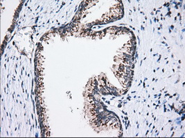 MOB1B / MOBKL1A Antibody - Immunohistochemical staining of paraffin-embedded Carcinoma of Human prostate tissue using anti-MOBKL1A mouse monoclonal antibody. (Dilution 1:50).