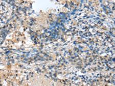 MOB4 / PHOCN Antibody - Immunohistochemistry of paraffin-embedded Human lung cancer tissue  using MOB4 Polyclonal Antibody at dilution of 1:25(×200)