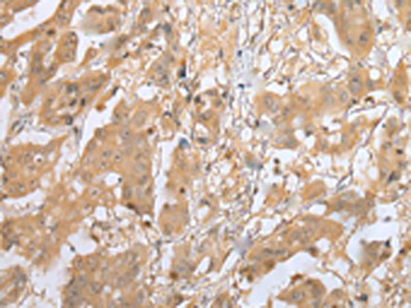 MOB4 / PHOCN Antibody - Immunohistochemistry of paraffin-embedded Human breast cancer tissue  using MOB4 Polyclonal Antibody at dilution of 1:25(×200)